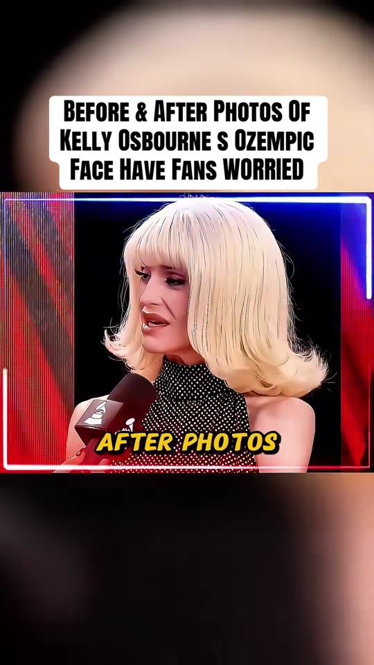 Does GLP-1 medication cause 'Ozempic face' in celebrities?