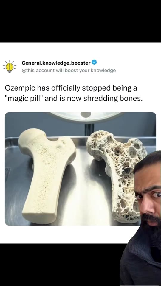 @dr.karanr's GLP-1 bone loss claims need context