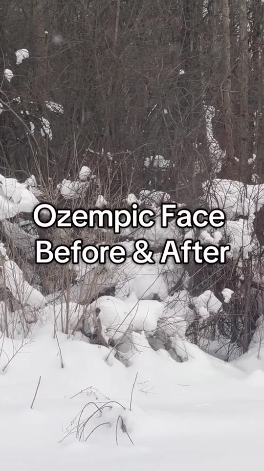 This TikTok about 'Ozempic face' needs more context