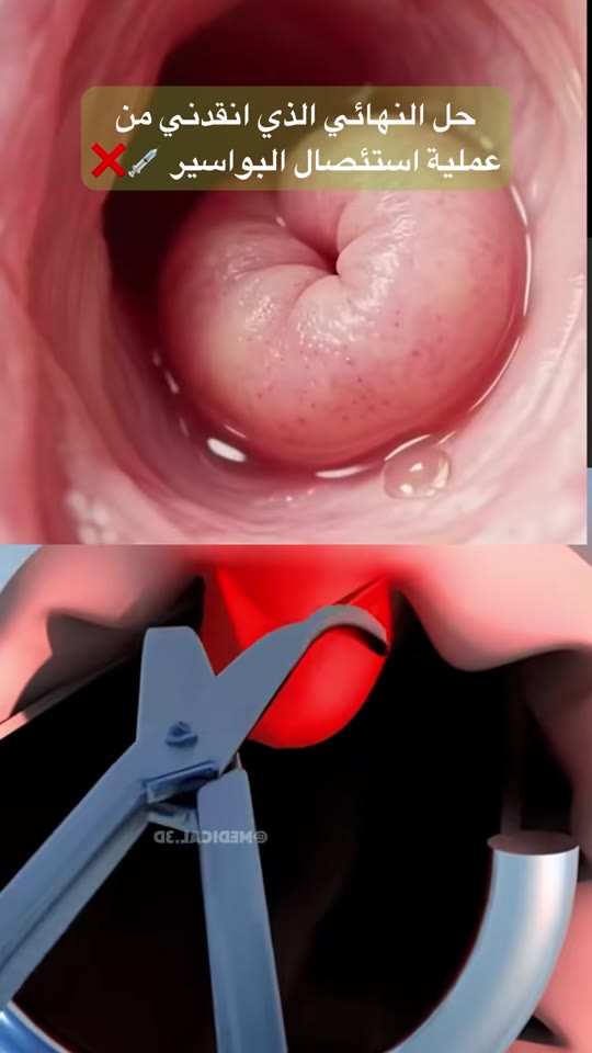 Herbal hemorrhoid spray claims: what the evidence actually says