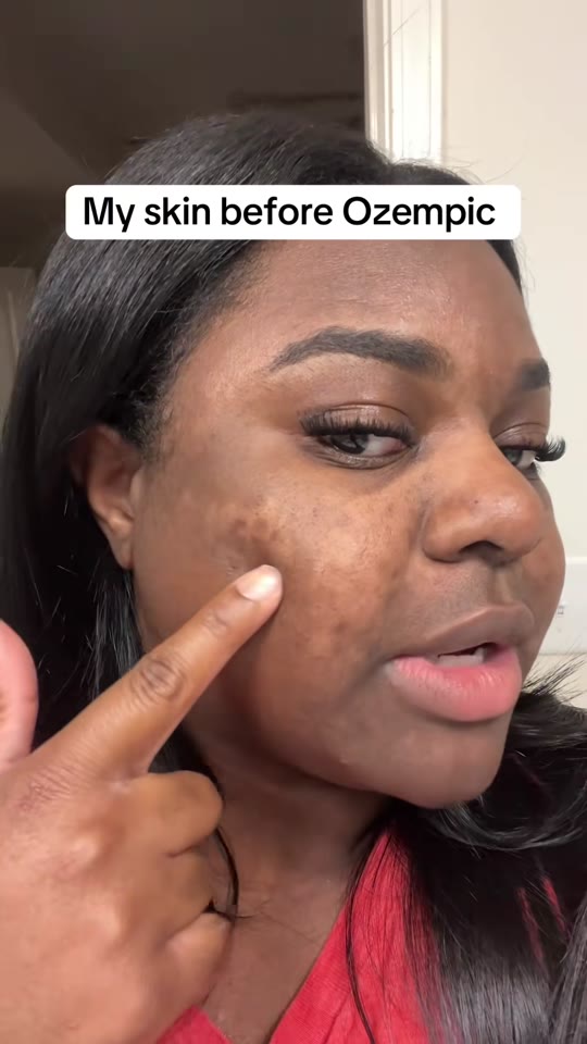 TikTok's skin transformation claims about GLP-1 drugs checked