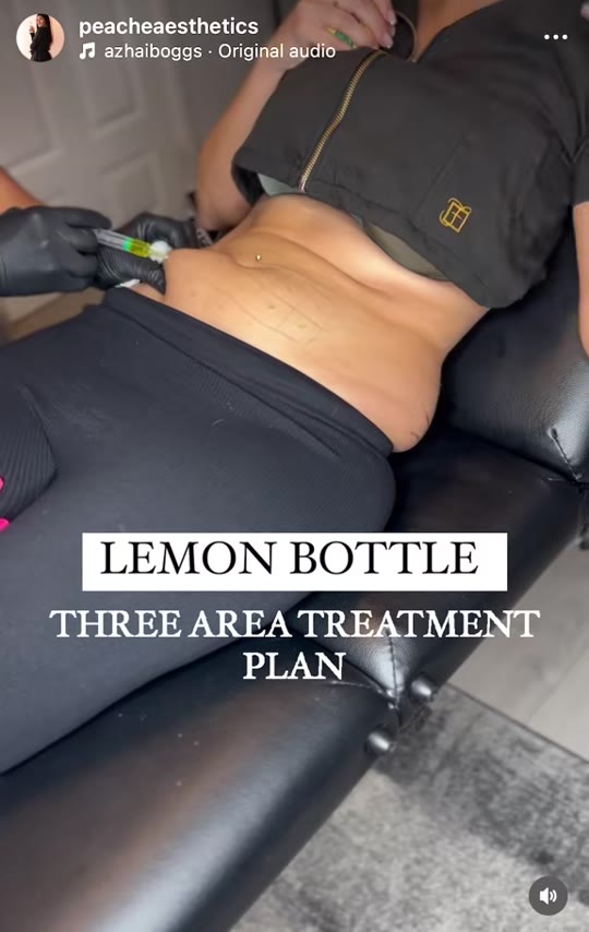 Lemon Bottle fat dissolving injections: what the evidence shows