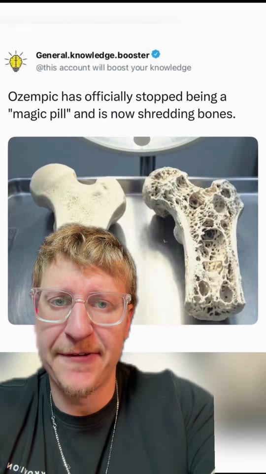 @thenutritionnarc's bone loss claims about Ozempic, fact-checked