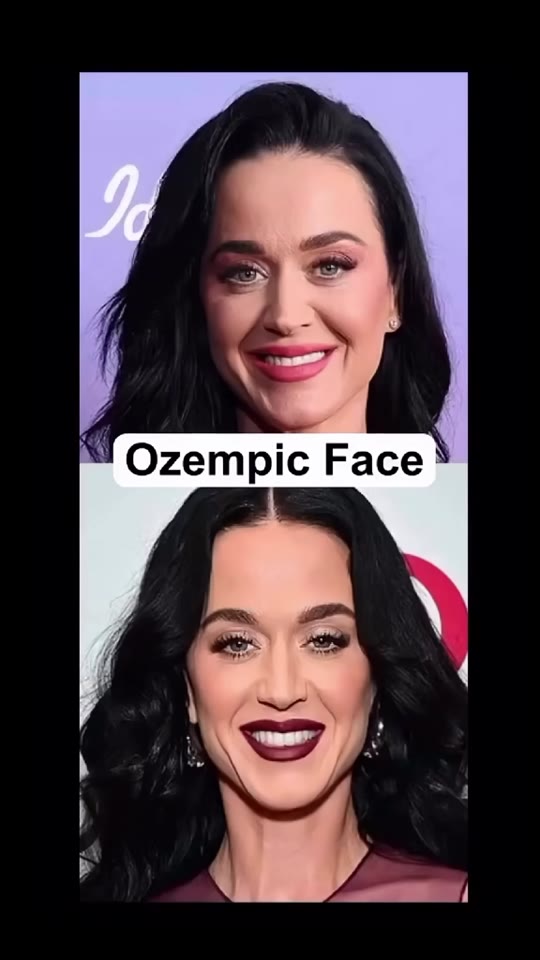 Does rapid weight loss really cause 'Ozempic face'? We checked