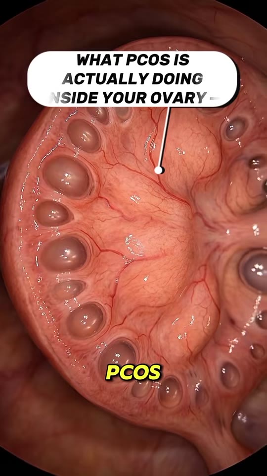 PCOS and follicle arrest: what the video gets right and wrong