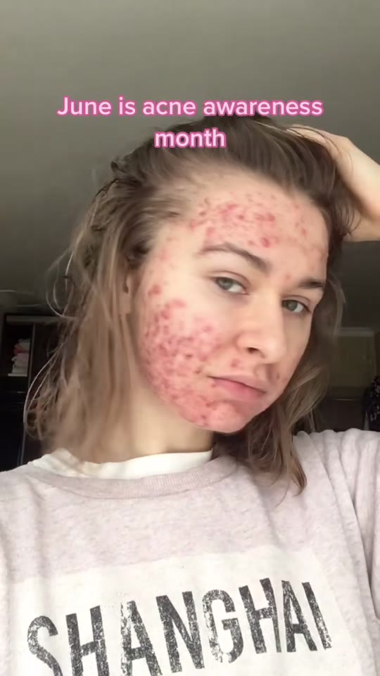 GHK-Cu and acne: separating peptide hype from skin science