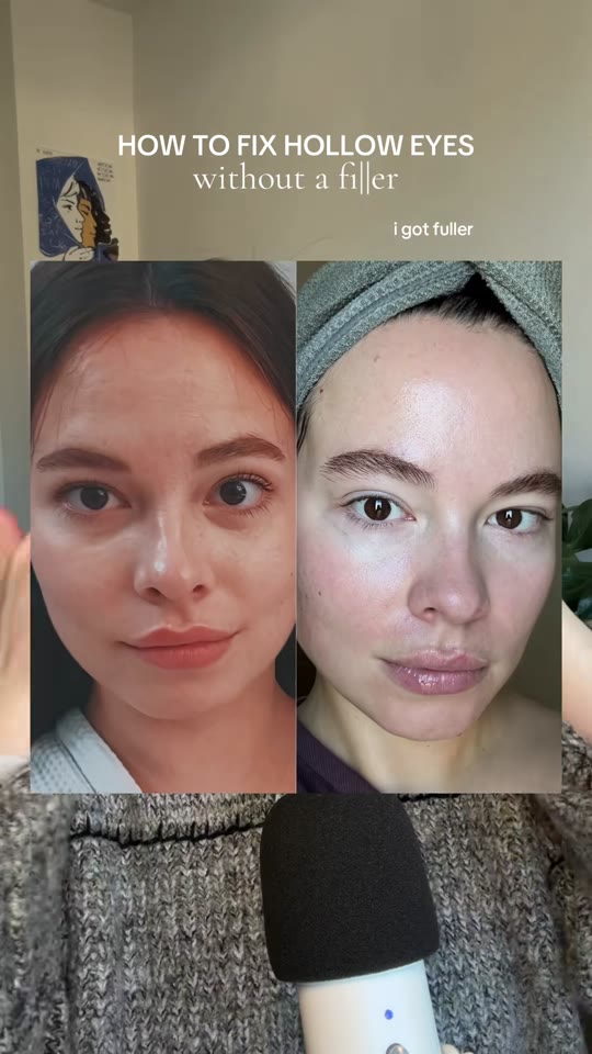Volufiline for hollow eyes: plump skin or paid hype?