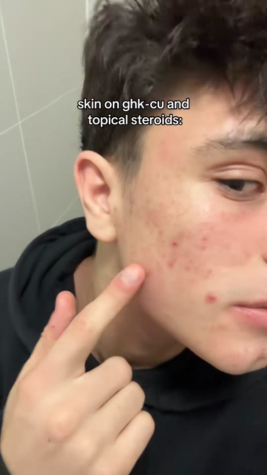 GHK-Cu for skin: promising peptide or overhyped TikTok trend?