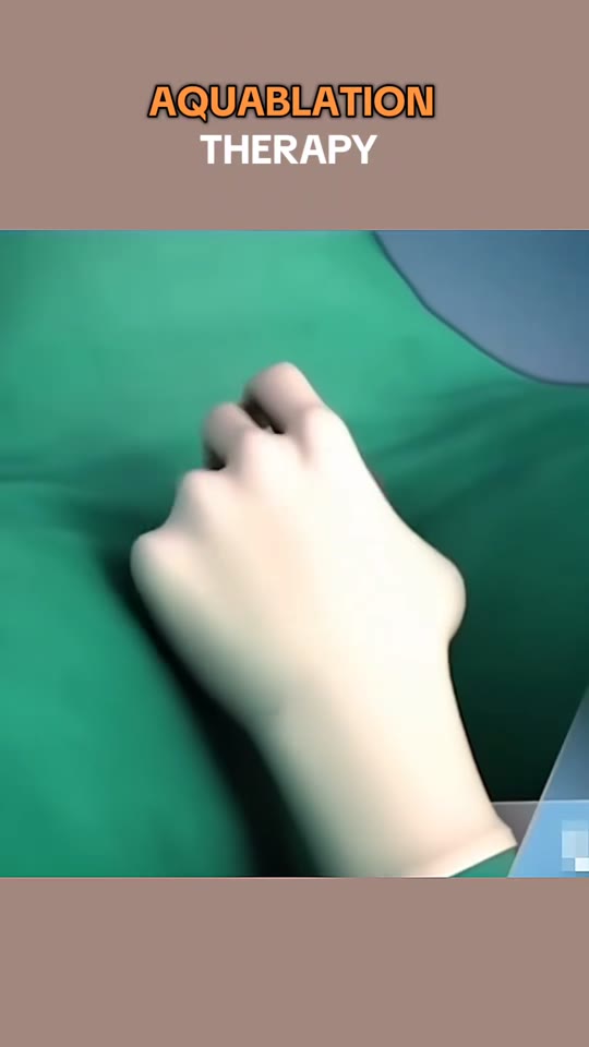 Aquablation therapy for BPH: what the evidence shows