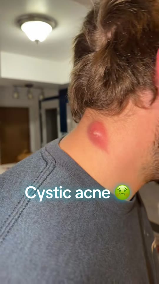 Peptides and cystic acne: what TikTok gets wrong about skin healing