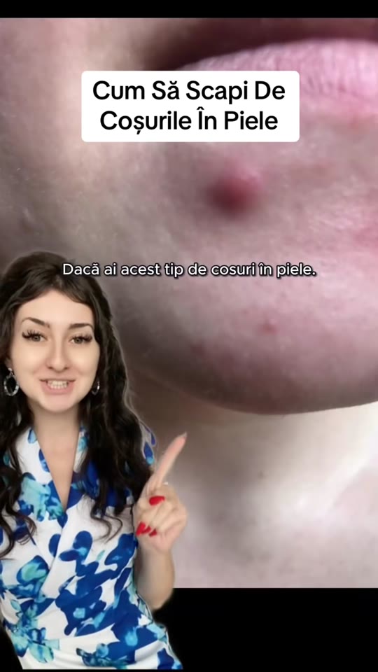 Can peptides like GHK-Cu actually cure acne permanently?