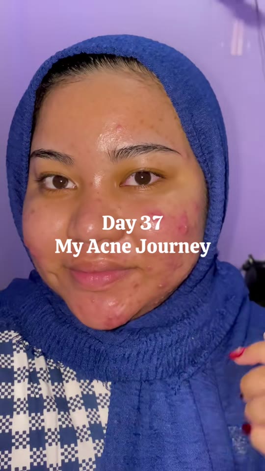 GHK-Cu and acne purging: what TikTok skips over