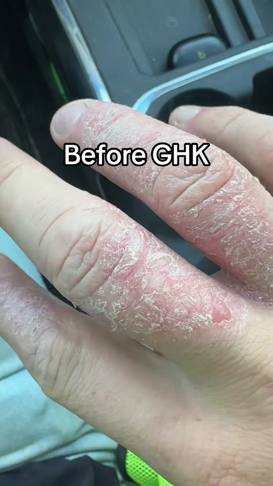 GHK-Cu peptide claims on TikTok: hype vs. actual evidence