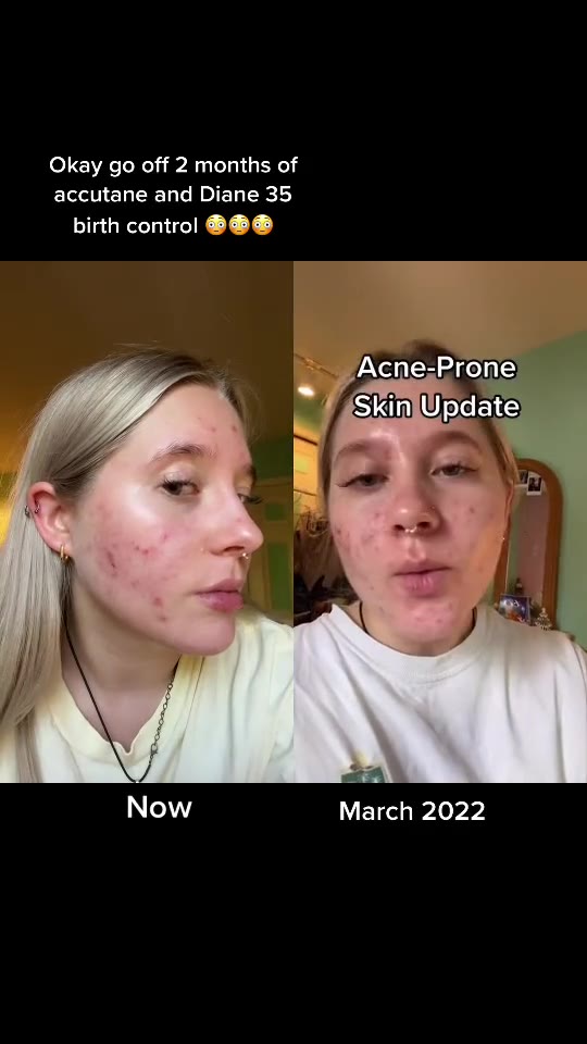 Accutane and Diane-35 for acne: what TikTok gets wrong