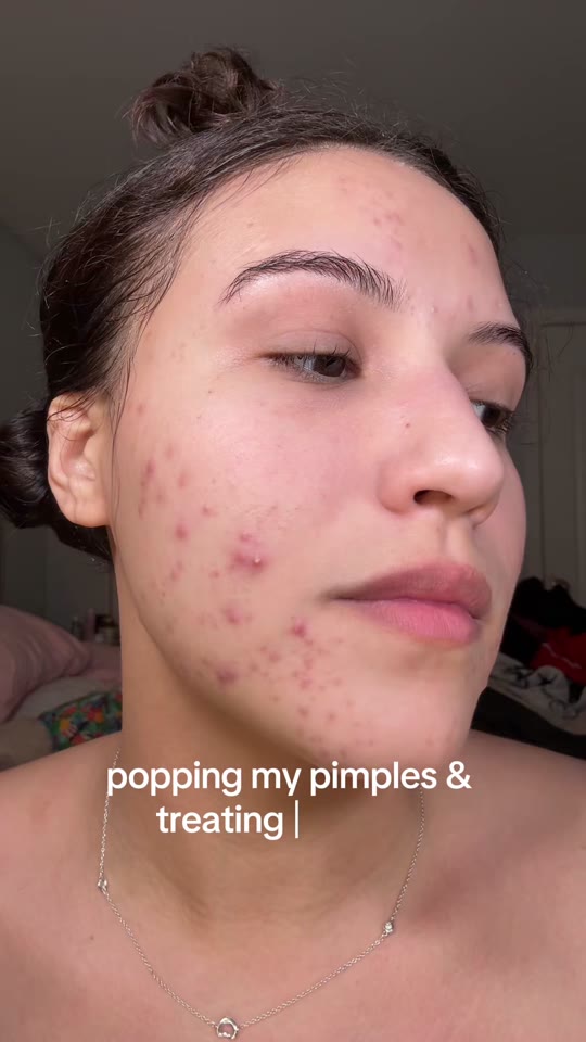 GHK-Cu and acne: what 3 weeks of results actually tells us