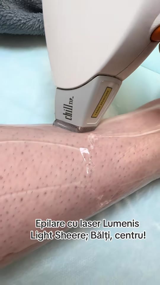 Laser hair removal claims on TikTok: what the evidence says