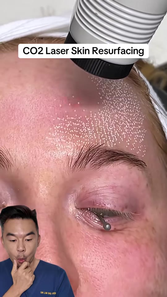 Fractional CO2 laser for acne scars: what the evidence says