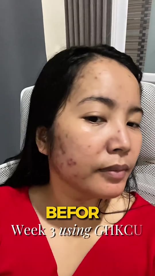 @peptideglowup's GHK-Cu acne claims, fact-checked