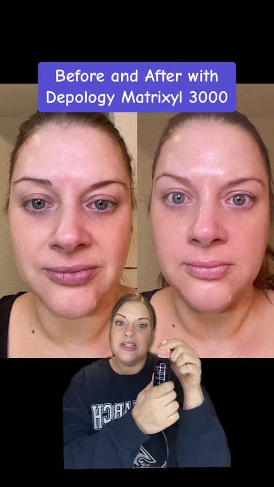 Does Matrixyl 3000 actually erase smile lines in three weeks?