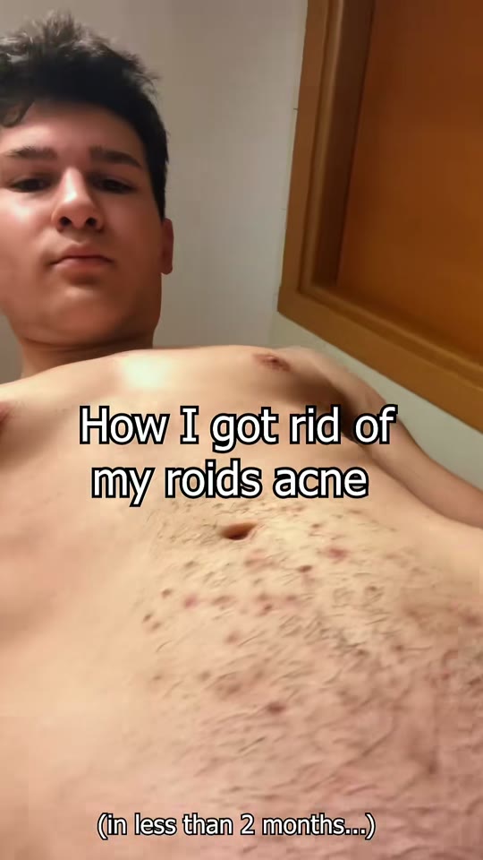 Steroid acne and peptides: what the evidence actually shows