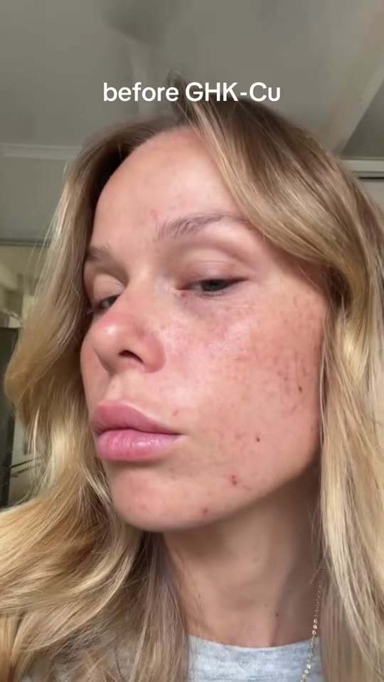 GHK-Cu peptide promises on TikTok don't match the science