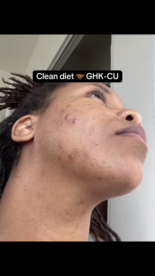 This TikToker's GHK-Cu acne claims, fact-checked