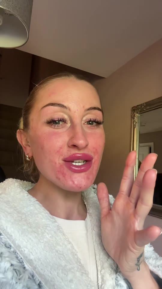 Duac gel and acne purging: what's actually happening to your skin