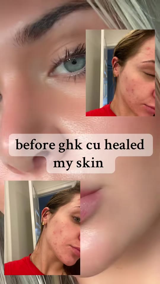 GHK-Cu for acne scars: what the evidence actually supports