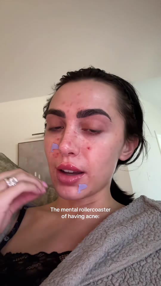 Do peptides like GHK-Cu actually clear stubborn acne?