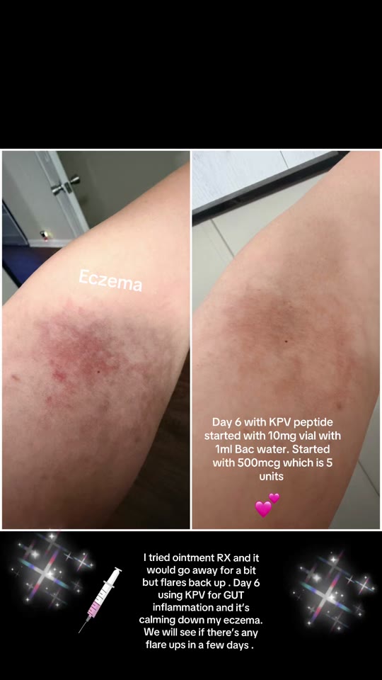 KPV peptide for eczema: what six days of gut dosing actually tells us