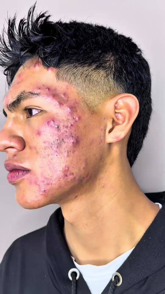 GHK-Cu and peptides for acne: what the skin data actually shows