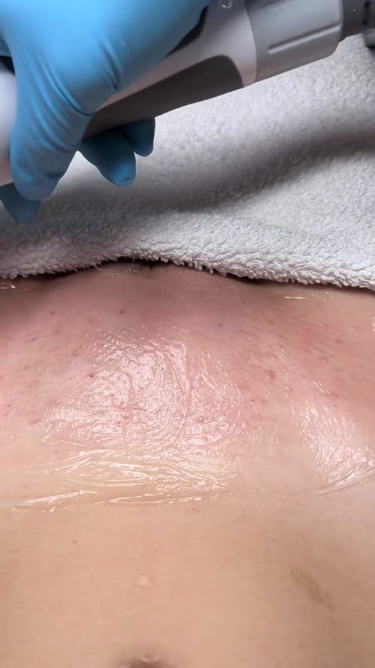 Diode laser hair removal: what 'permanent' actually means
