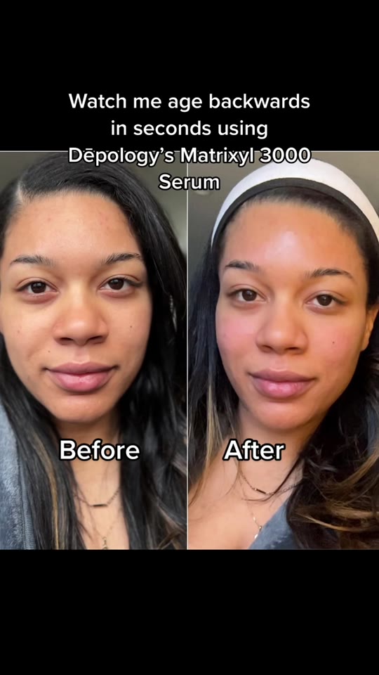 Matrixyl 3000 'age backwards' claims: what the science says