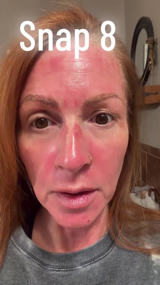 Snap-8 peptide with microneedling: what the science supports