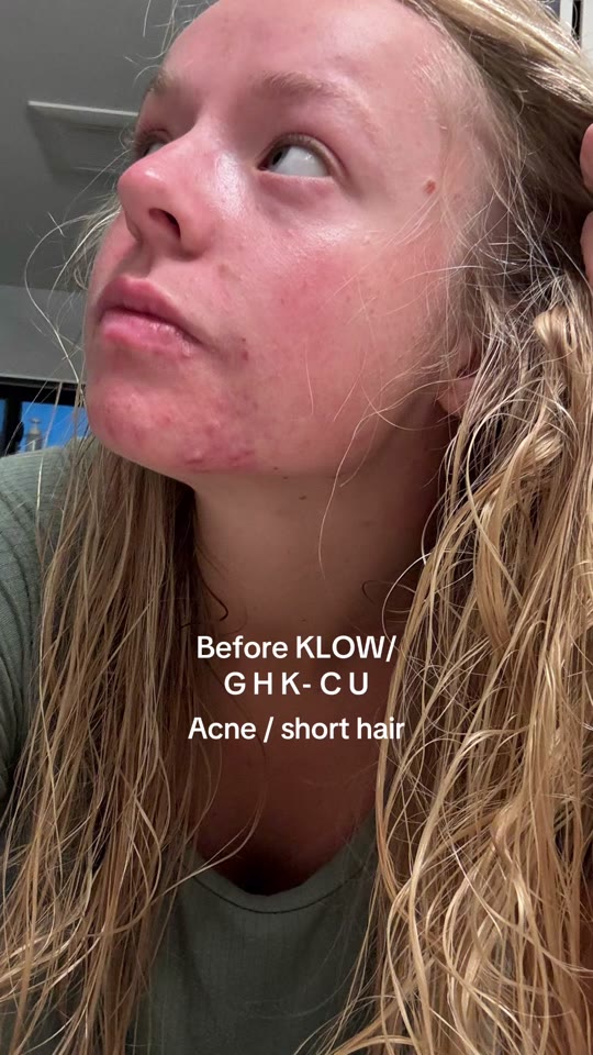 GHK-Cu for acne: what the peptide science actually shows