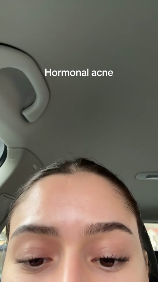 GHK-Cu and hormonal acne: what TikTok skips over