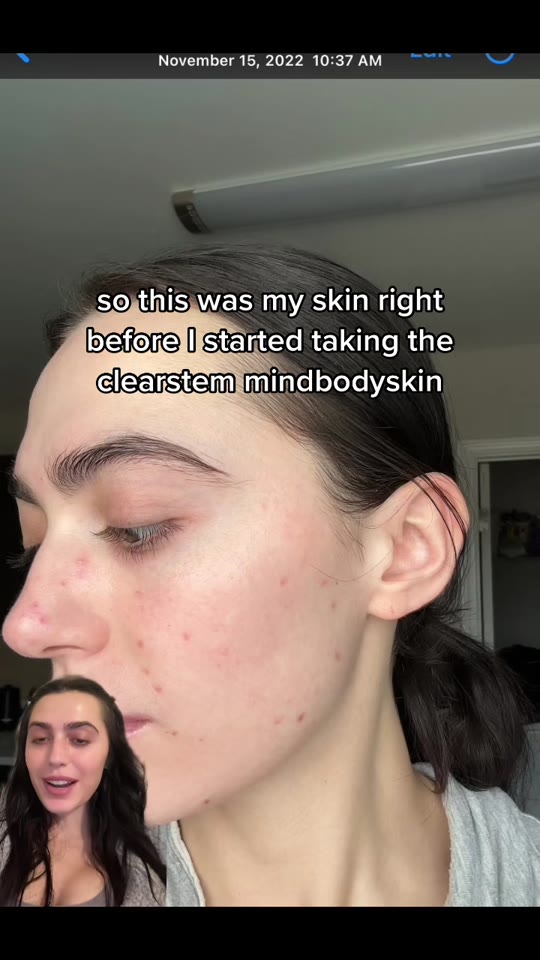 Clearstem supplement vs. accutane: what the evidence shows