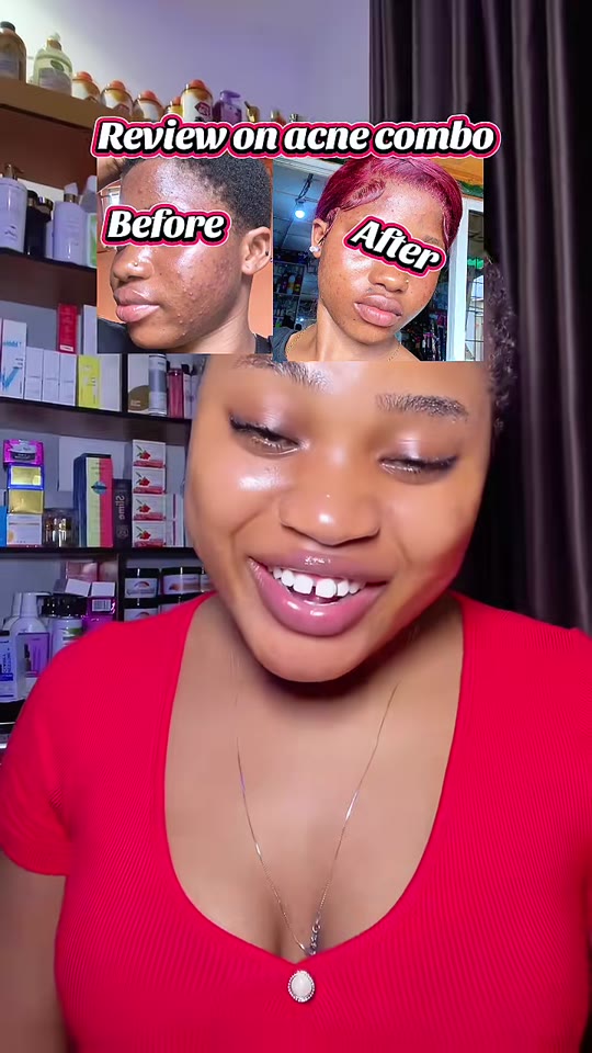 GHK-Cu for acne: what the peptide science actually shows