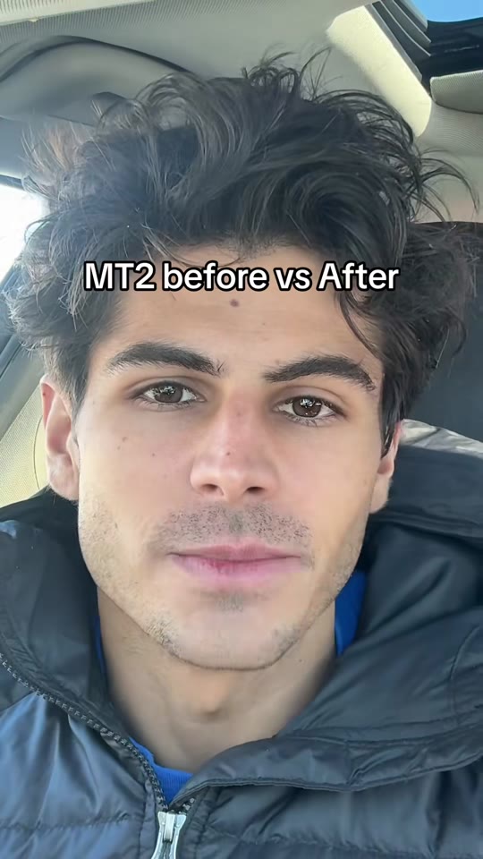 Melanotan II and winter tanning: what TikTok won't tell you