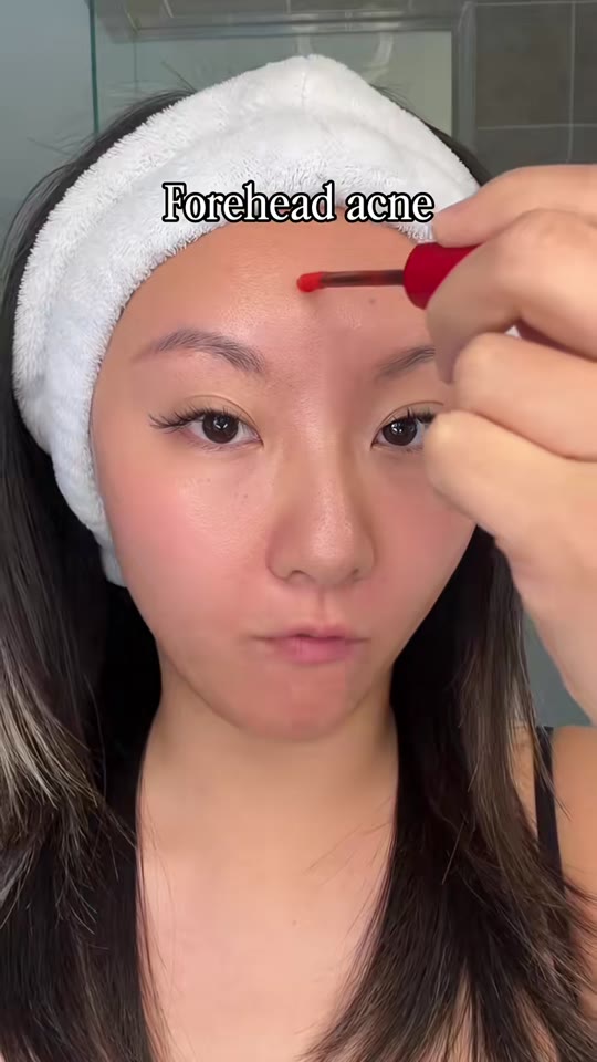 TCM and acne on TikTok: what the science actually says