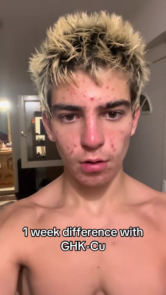 @pepso111's peptide acne claims need more evidence