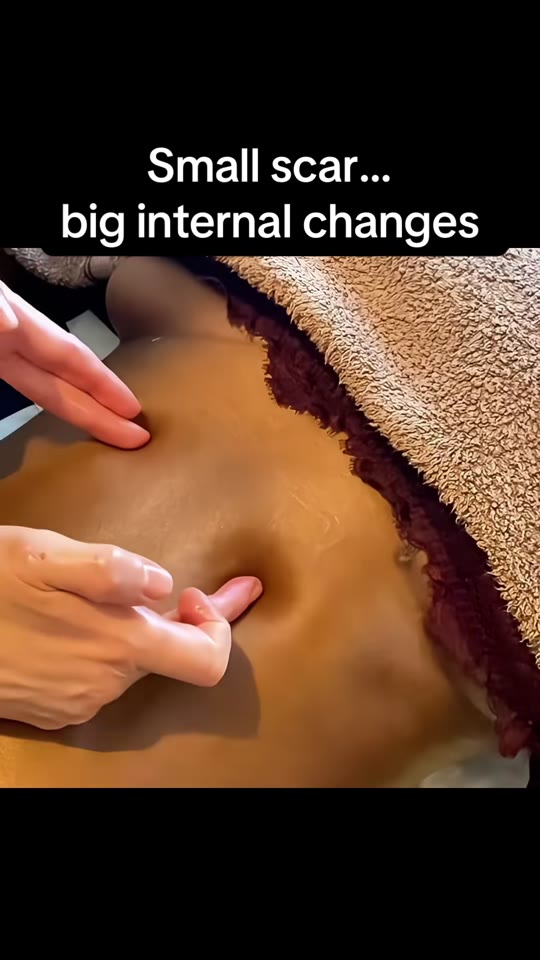 Does muscle repair surgery really leave hidden internal scar tissue?