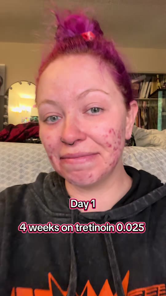 @littlemissdicey's tretinoin progress claims, fact-checked