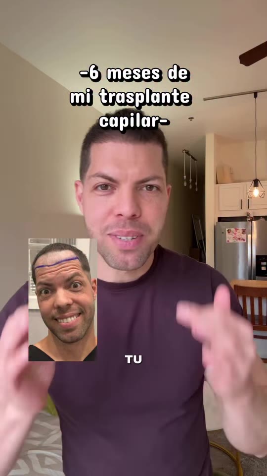 @belangelvzla's hair transplant update, fact-checked