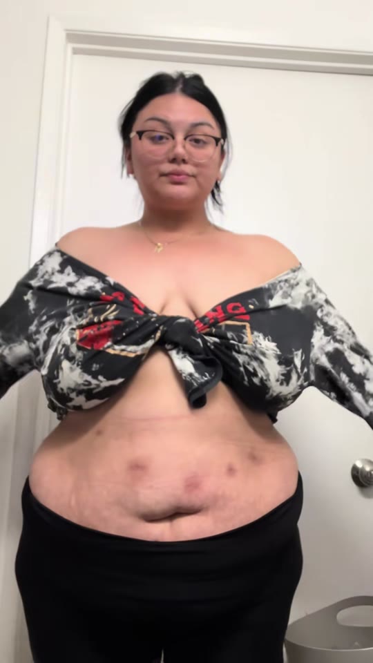 VSG at one year: what TRT actually does to weight loss outcomes