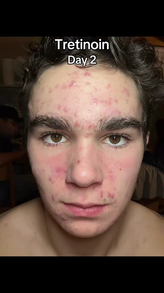 Tretinoin timelines and jumping to accutane: what the evidence says