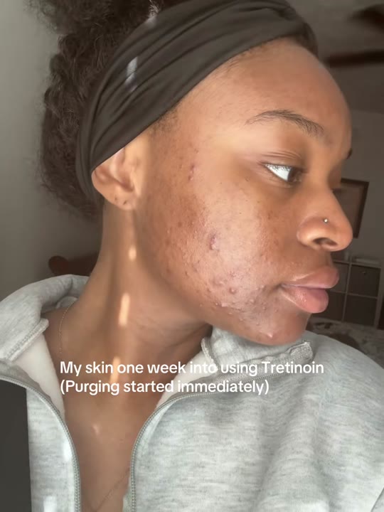 This tretinoin TikTok got the category completely wrong