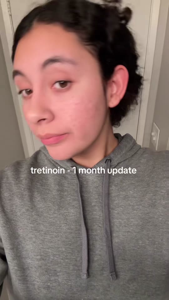 @angelavinee's tretinoin purging claims, fact-checked