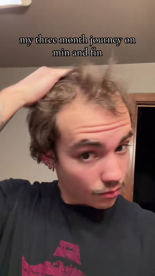 @vannposp's hair loss claims need some context