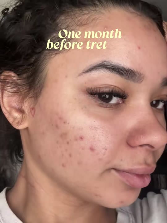 Hormonal acne and tretinoin: separating TikTok claims from clinical evidence